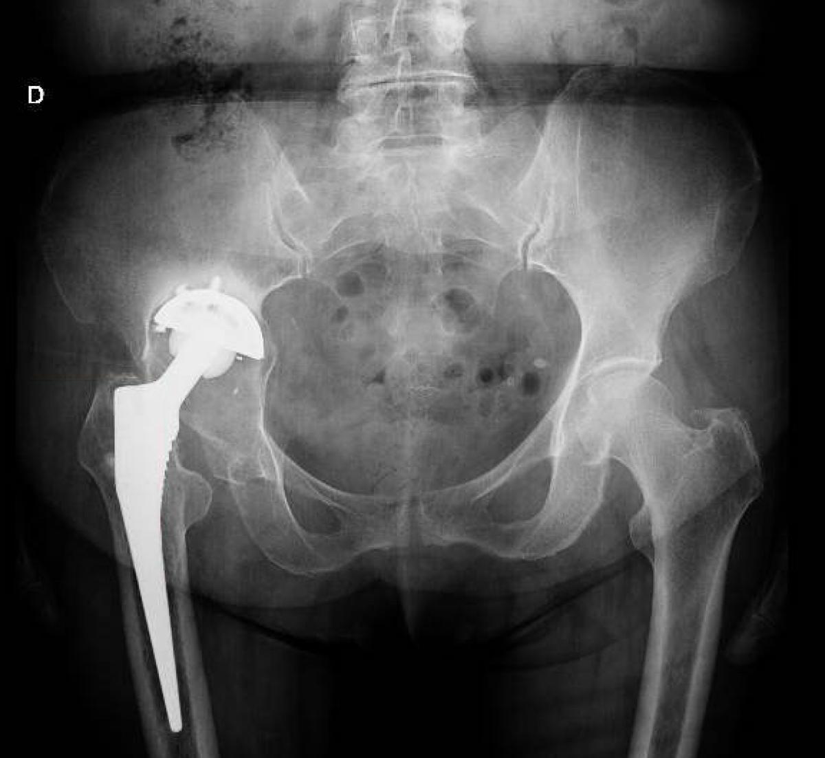 Esta operación se crea un espacio entre el tensor de la fascia lata y los músculos sartorios que permiten el acceso a través de la cápsula anterior de la cadera