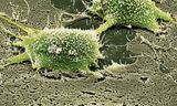 A tumor cell in the colon that is on the verge of cell division. CAR T cell therapies are often less suitable for such solid tumors.  