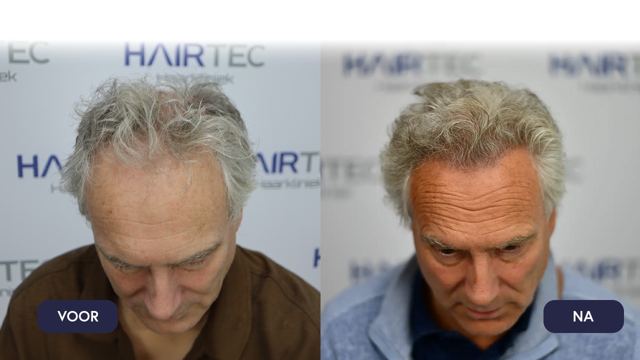 Hair transplant the Netherlands before and after photos