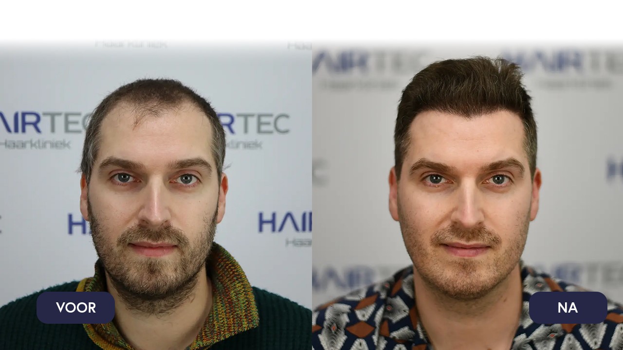 Hair transplantation Turkey Delft Tom Dice before and after photo