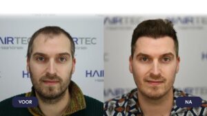 Hair transplantation Turkey Delft Tom Dice before and after photo
