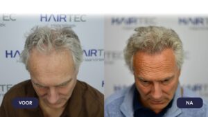 Hair transplant the Netherlands before and after photos