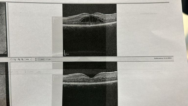 Upstairs: In the eye ball with DCMD. Below: a healthy eyeball (photo: via Wim Bekkers)