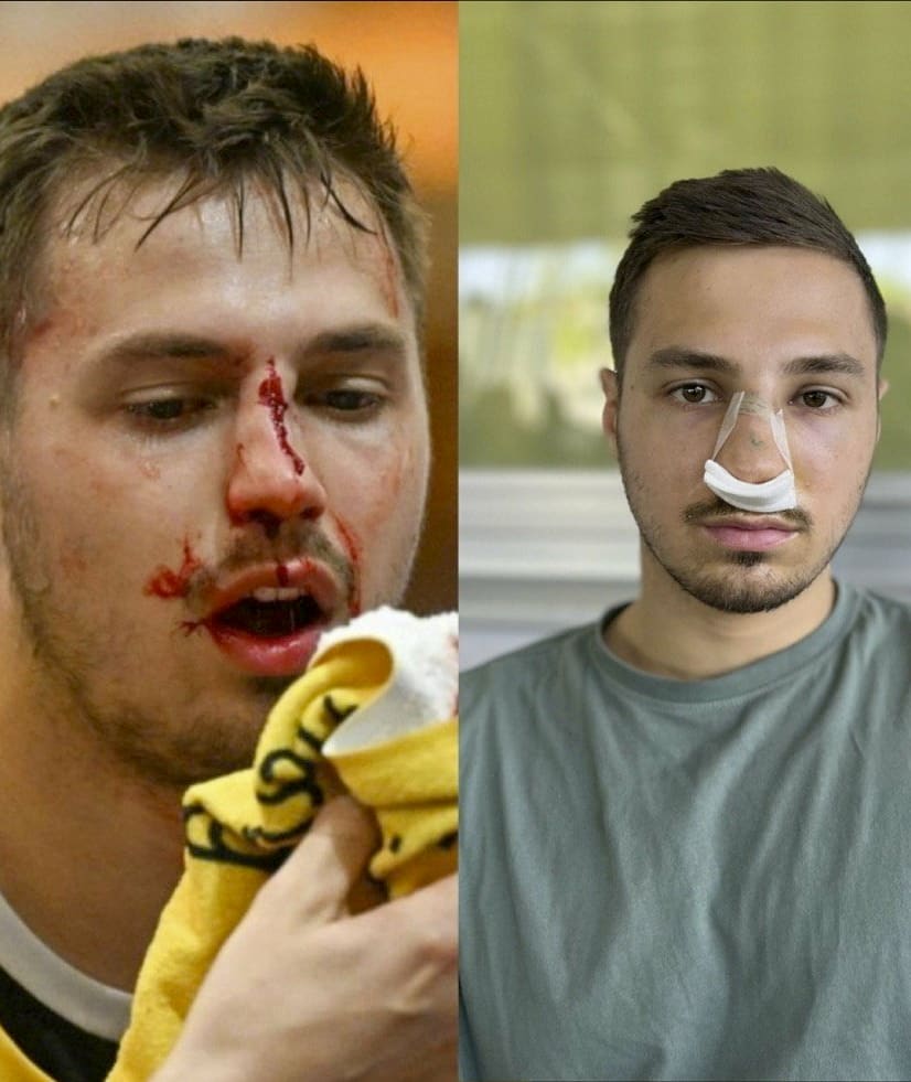 Markus Mahr während des Unfalls und nach der Nasen-OP