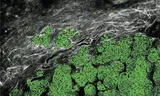 A metastasis of breast cancer in the brain. In green the cancer cells. In the gray connective tissue threads (collagen) and blood vessels. 