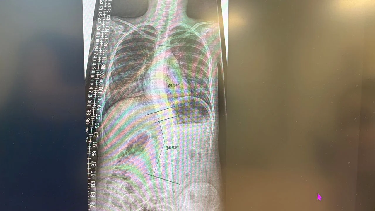 The curvature in Veerle's back is so bad that she has to wear a brace 23 hours a day (photo: Omroep Brabant).