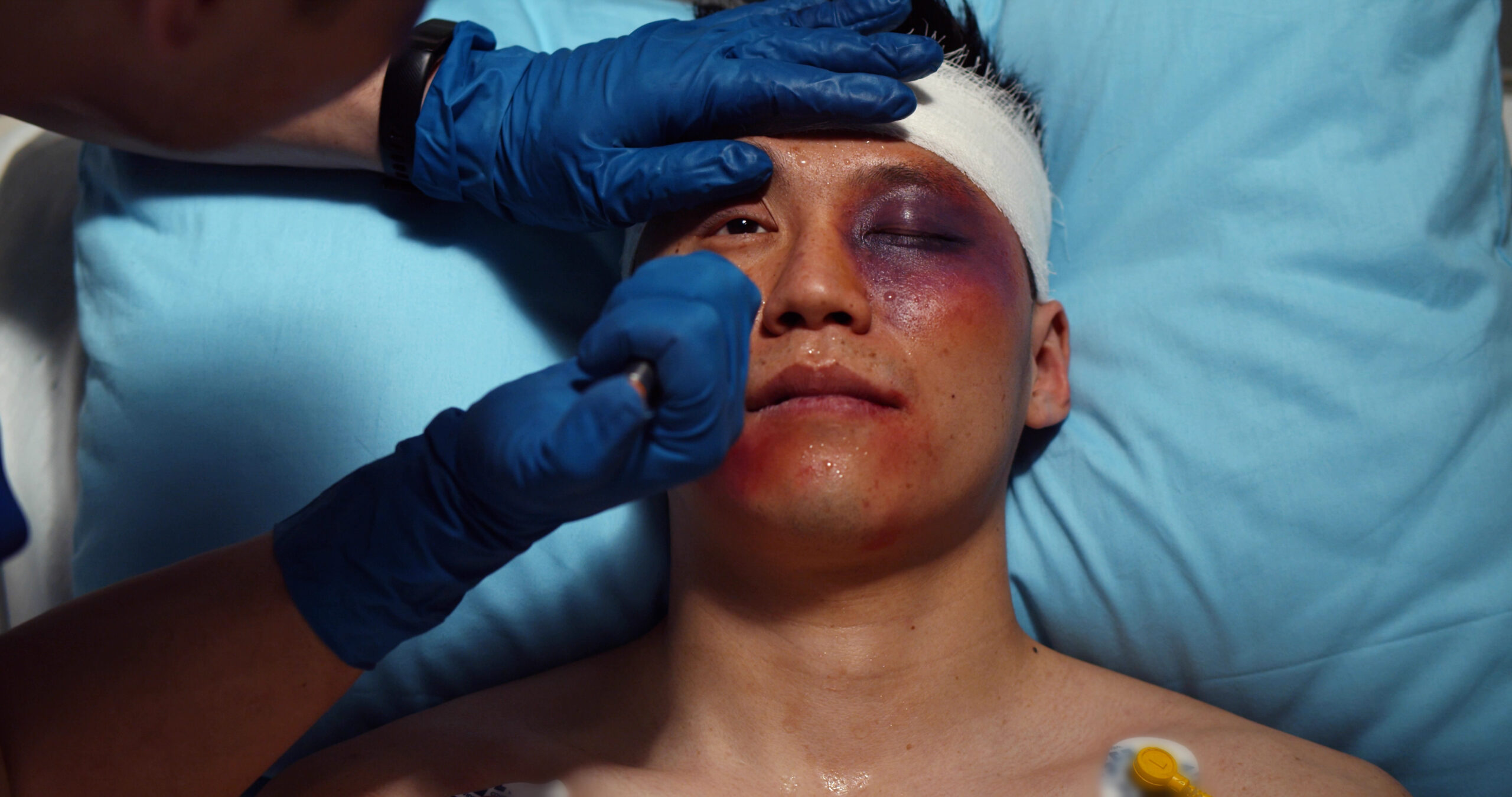 13-Second Eye Test May Predict Consciousness Recovery After Brain Injury