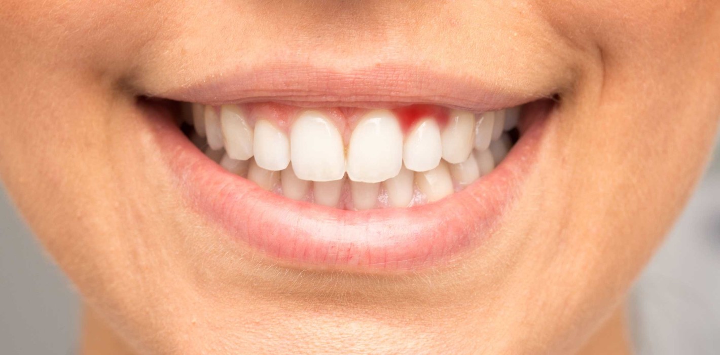Could Postbiotics Help Reduce Gum Inflammation? Discover the Study Results!