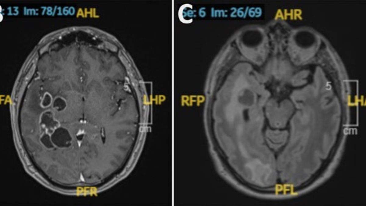 Doctors Mistook Brain Tumor for Years: Man Had Tapeworms Unnoticed