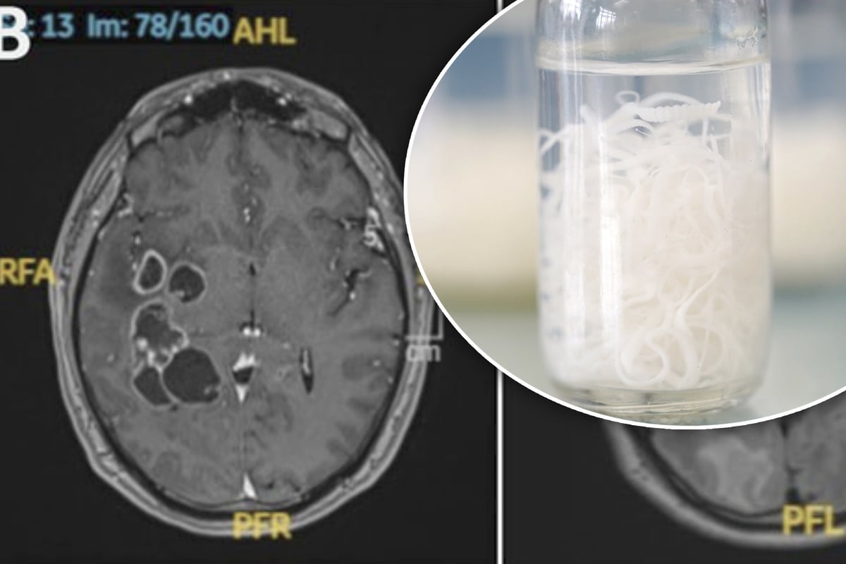 Doctors Search for Cancer, But Find Unexpected Brain Infection Instead