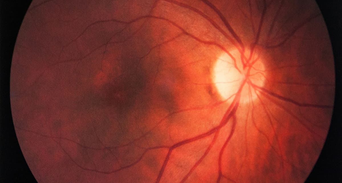 Effective Dexamethasone Implant Treatment for Diabetic Macular Edema Revealed