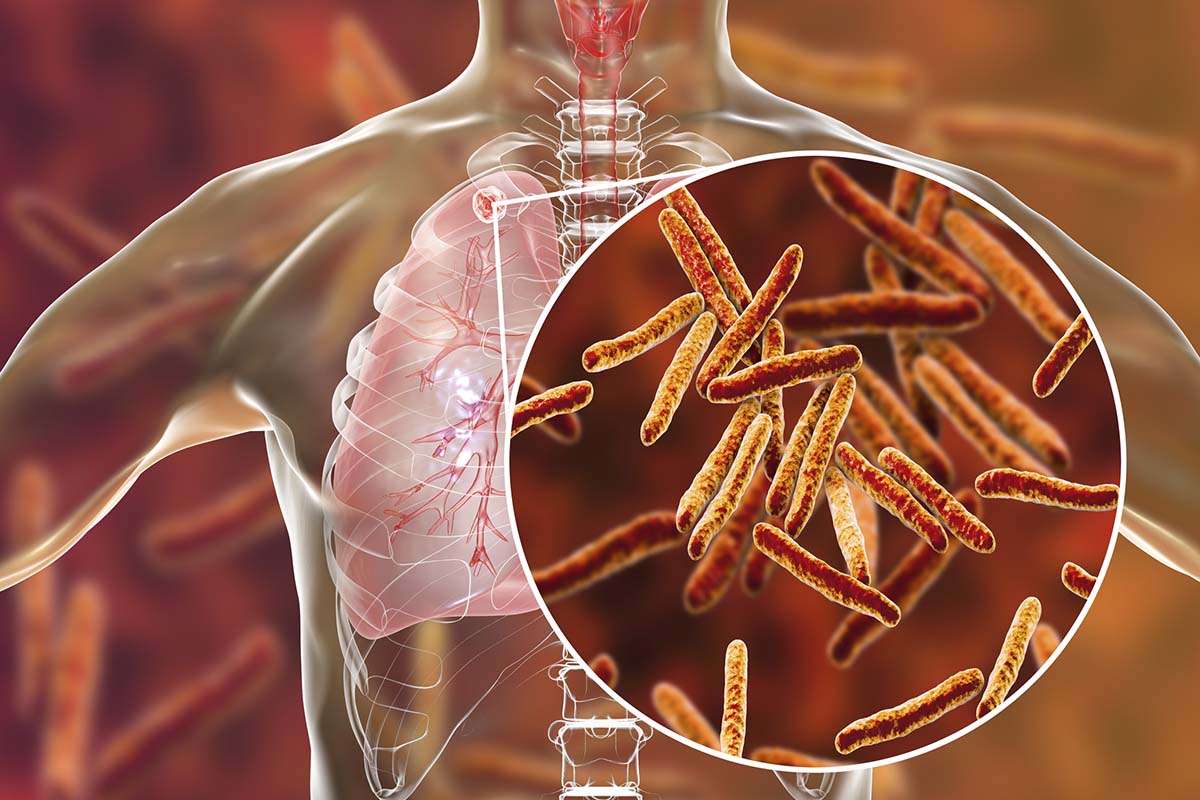 Genomic Sequencing Reveals Hidden Drug Resistance in Tuberculosis Patients
