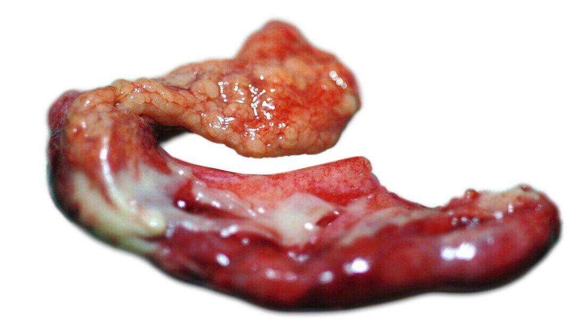 Inflamed Appendix: Key Driver in Colitis Ulcerosa Progression?