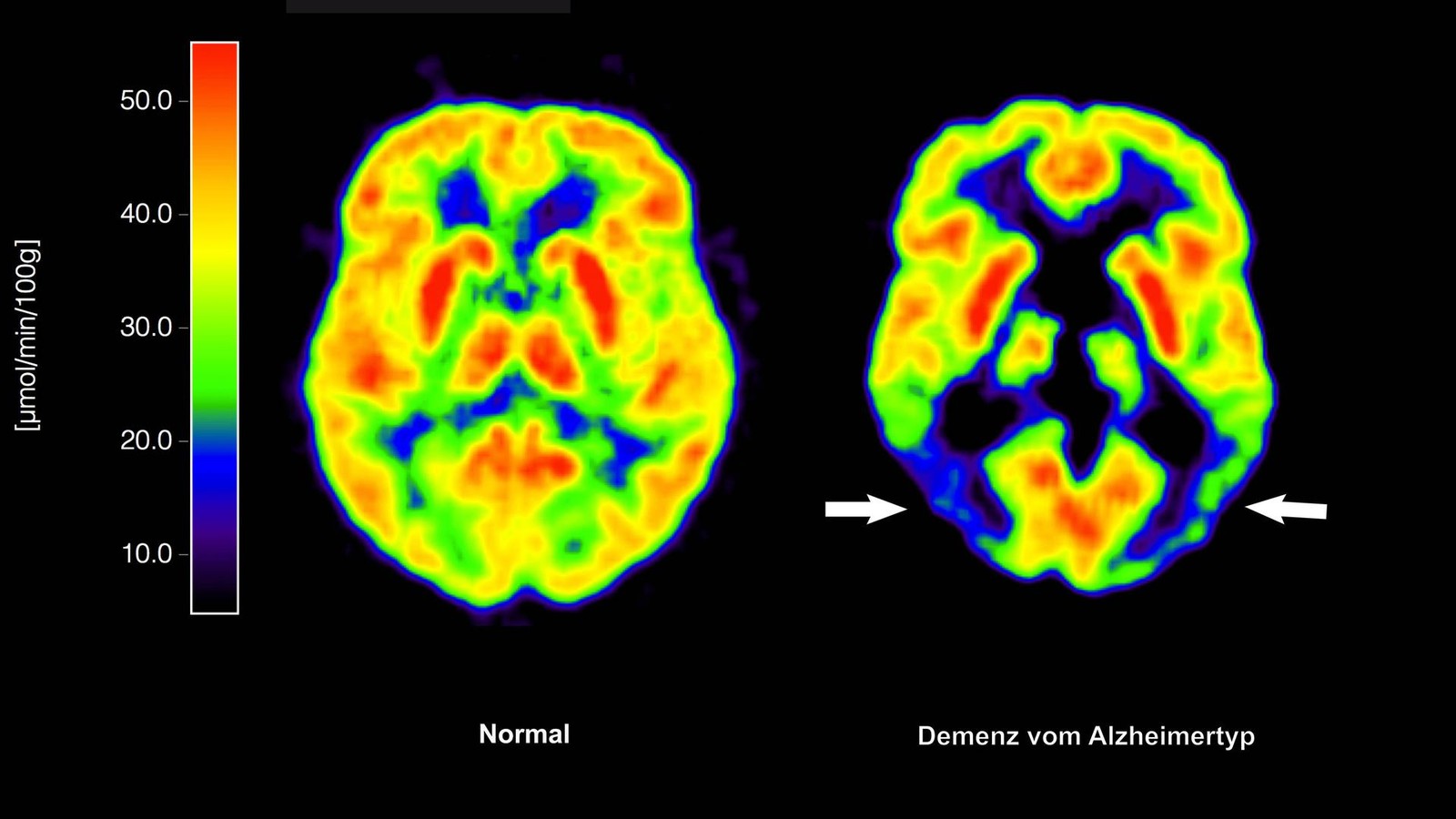 Is Glucosamine a Hidden Risk Factor for Alzheimer’s Disease?