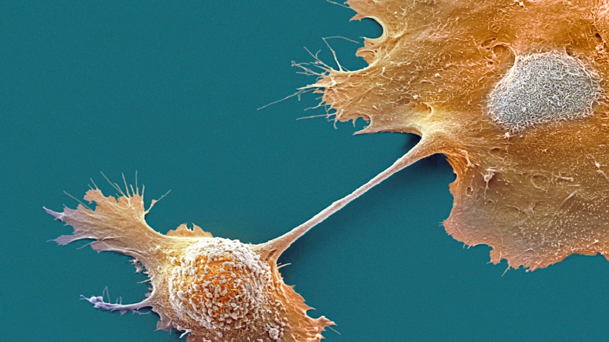 New Insights: Cancer Markers Found in Healthy Pancreas Cells