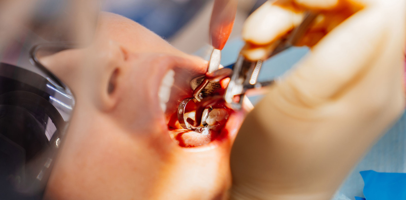 Aloe Vera Nanoparticles in Hemostatic Sponges: Breakthrough in Tooth Extraction?
