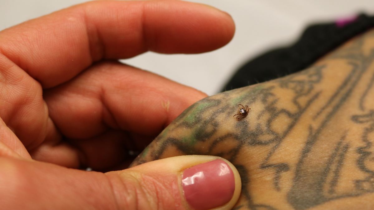 Alpha-Gal Syndrome in the USA: Tick Bites and Misleading Antibody Tests