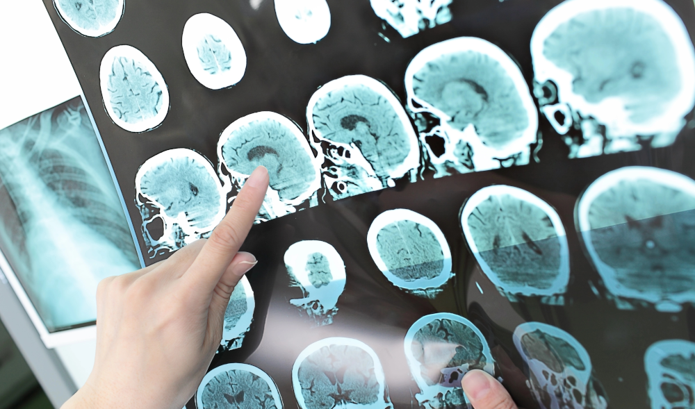 CO₂ Inhalation Boosts Alzheimer Protein Removal: Sleep-Like Glymphatic Action