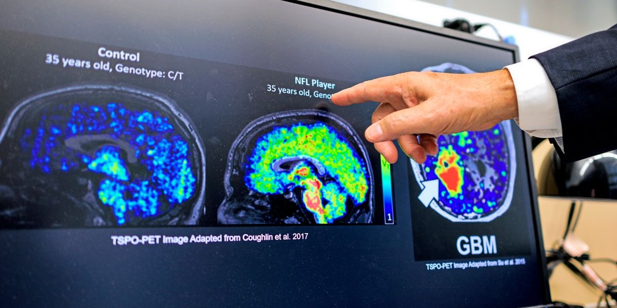 Could the Brain’s ‘Inflammation Brake’ Help Prevent Alzheimer’s?