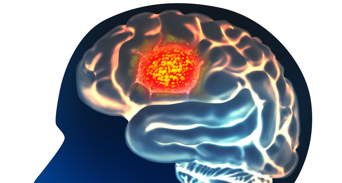 Does Intraoperative Radiation Therapy for Glioblastoma Offer Any Benefits?