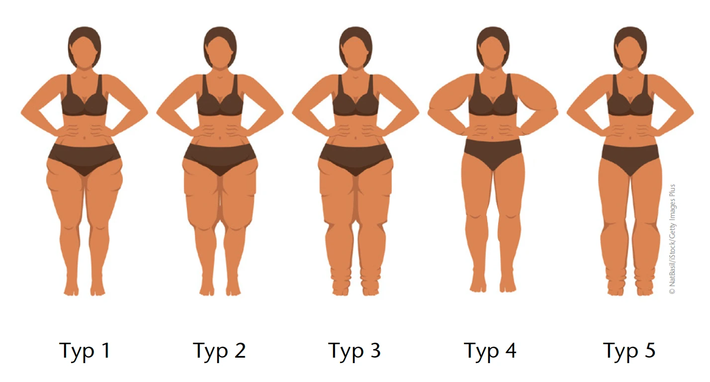 Effective Nutritional Therapy Options for Lipedema Relief