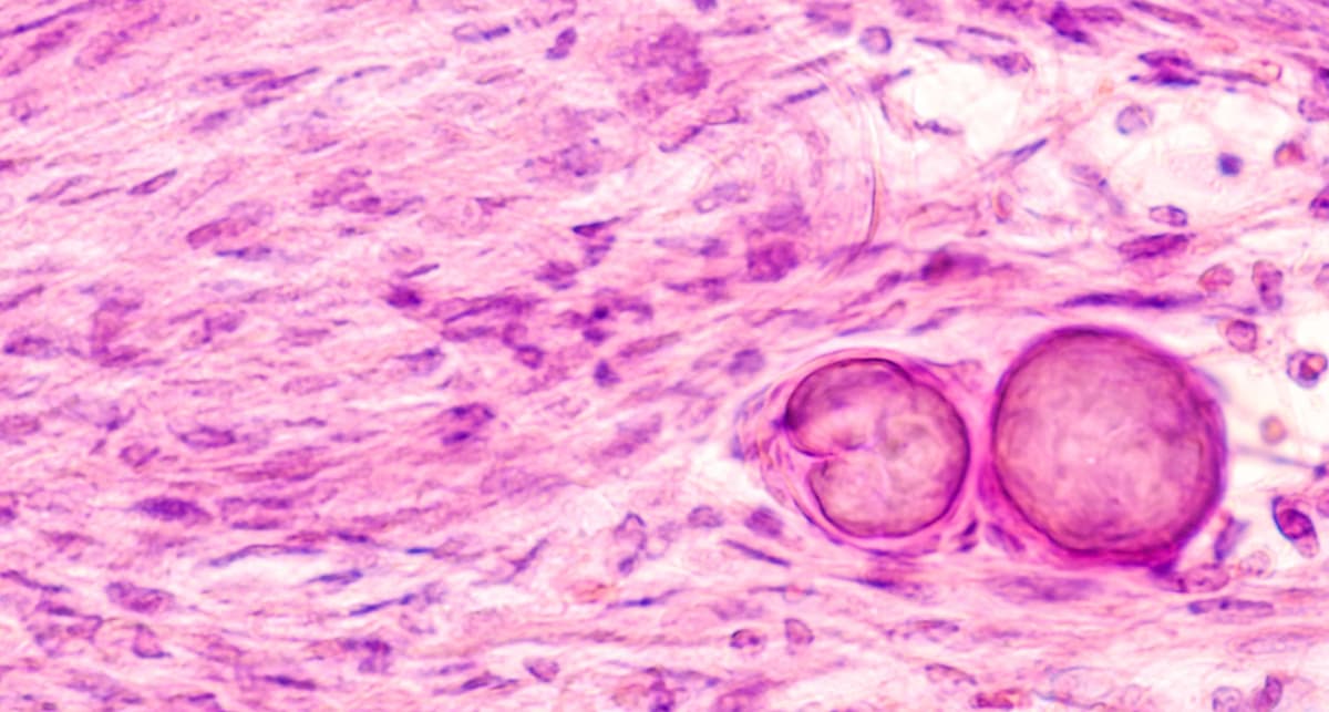 Elevated Meningioma Risk: What Women Should Know About Gestagens