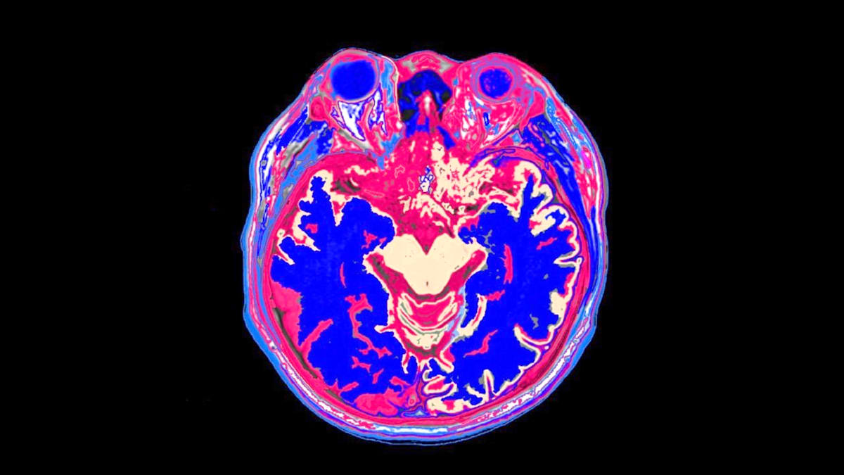 Frequent TV Watching: How It May Increase Dementia Risk and Alter Your Brain