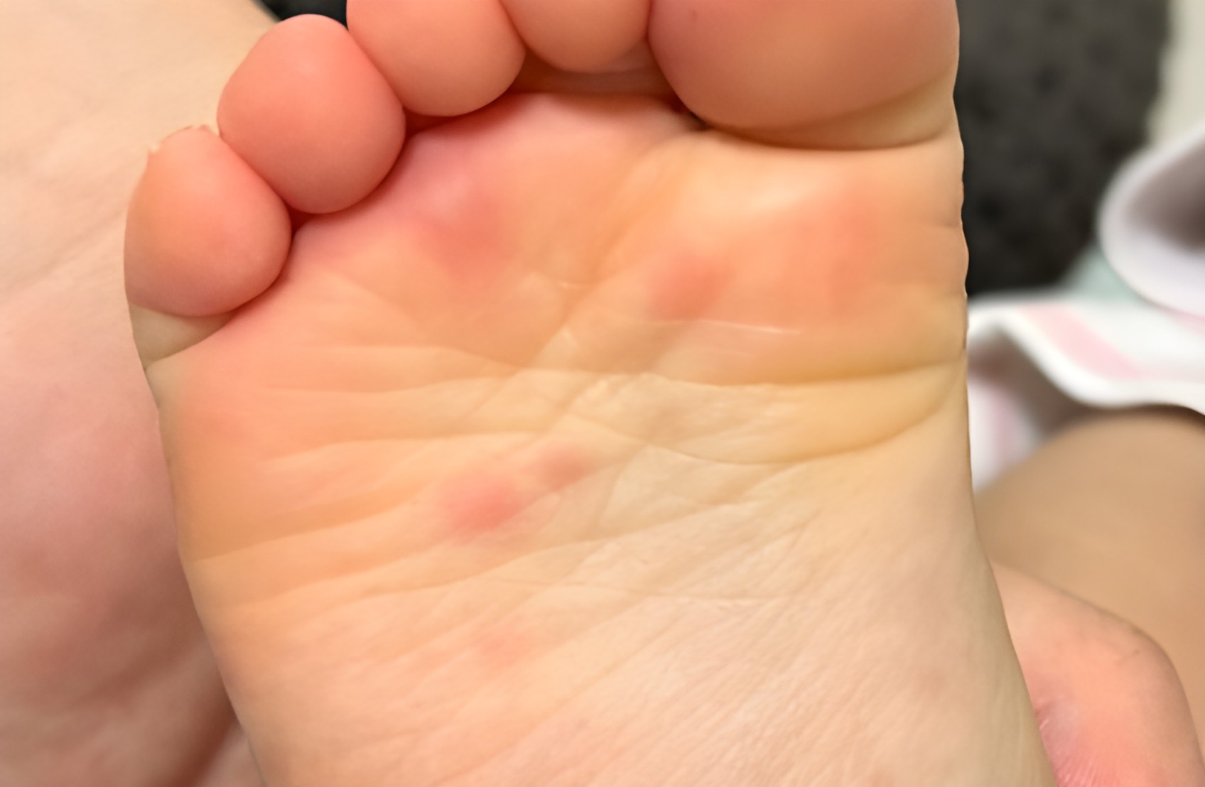 Hand-Foot-Mouth Disease: Rising Cases Among Children in Japan