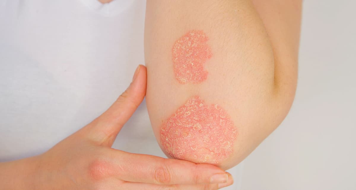 High BMI Impedes Achieving Minimal Disease Activity in Psoriasis Arthritis