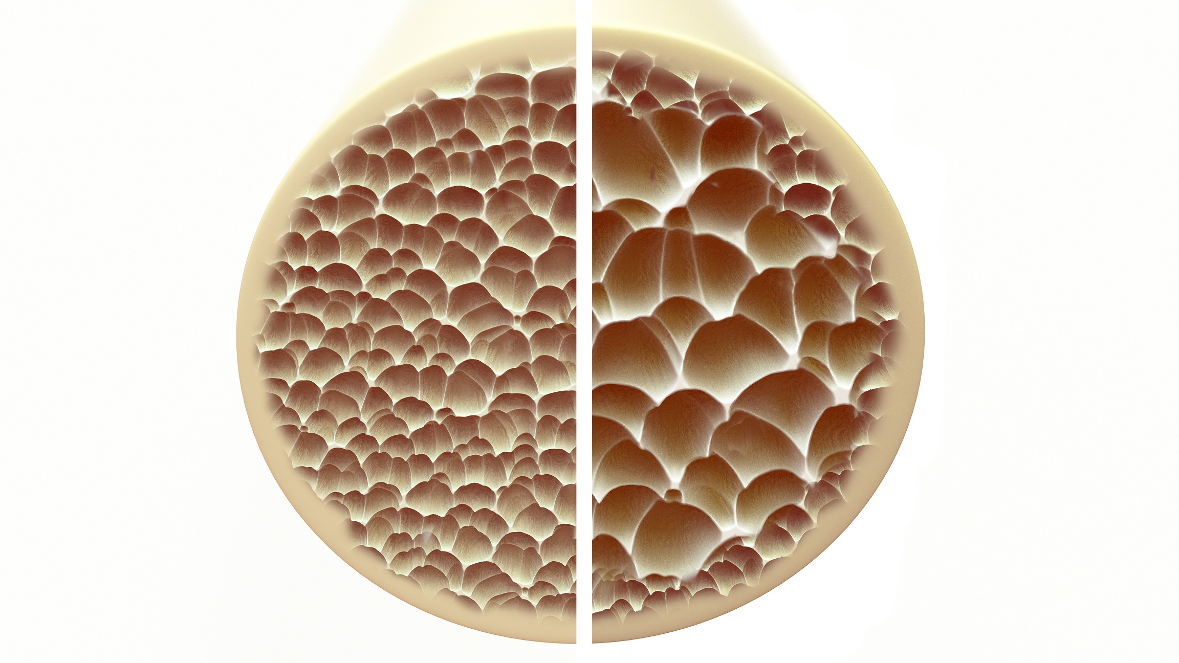 How Osteoporosis Significantly Raises Early Mortality Risk in Women