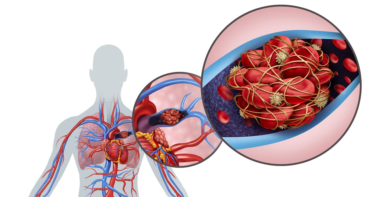 How the YEARS Algorithm Estimates Thrombosis Risk in Cancer Patients