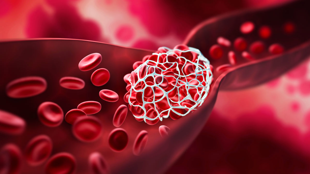 Innovative Method to Prevent Heart Attacks and Strokes Without Blood Thinning Risks