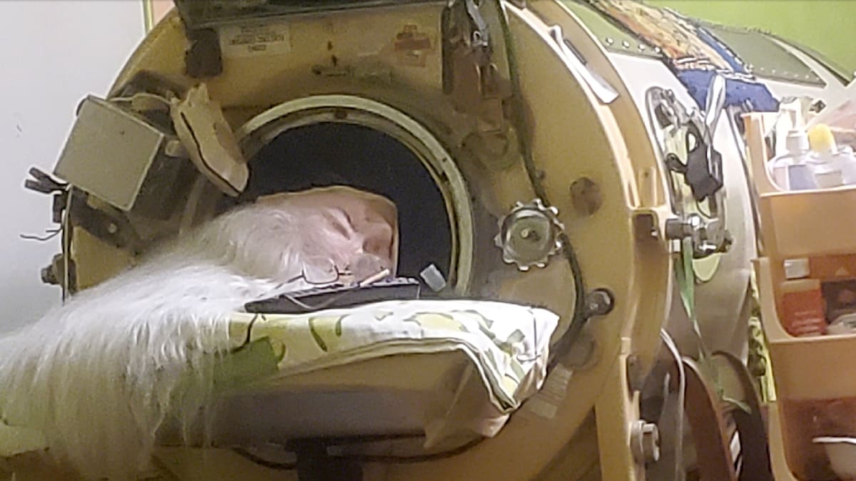 Last Iron Lung Patient Dies: A 70-Year Legacy of Medical History