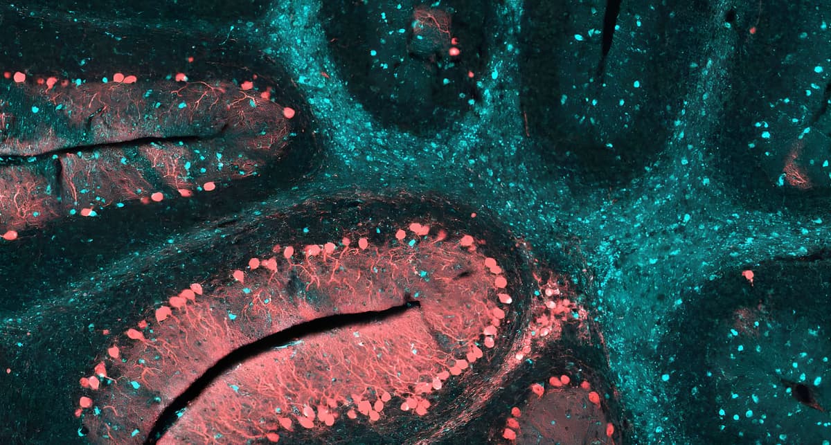 Levacetylleucin: Promising Neurological Benefits for Niemann-Pick Disease