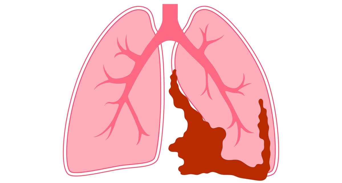 Mesothelioma: A Persistent Health Challenge Despite Asbestos Regulations