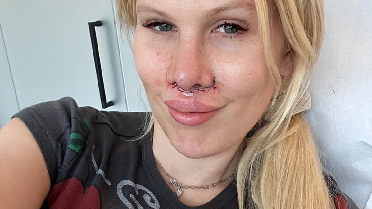 Naive Decisions: Reality Star’s Warning on Risky Beauty Surgeries in Turkey