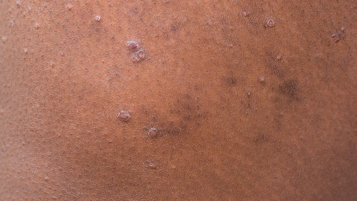 New Guidelines for Managing Prurigo Nodularis: Key Recommendations Unveiled