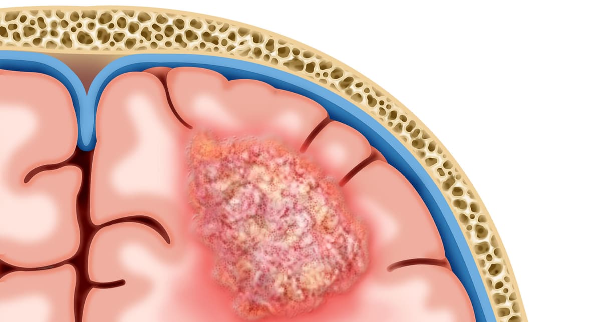 New TAA Cell Therapy for Pediatric Gliomas: A Game-Changer from CAR-T