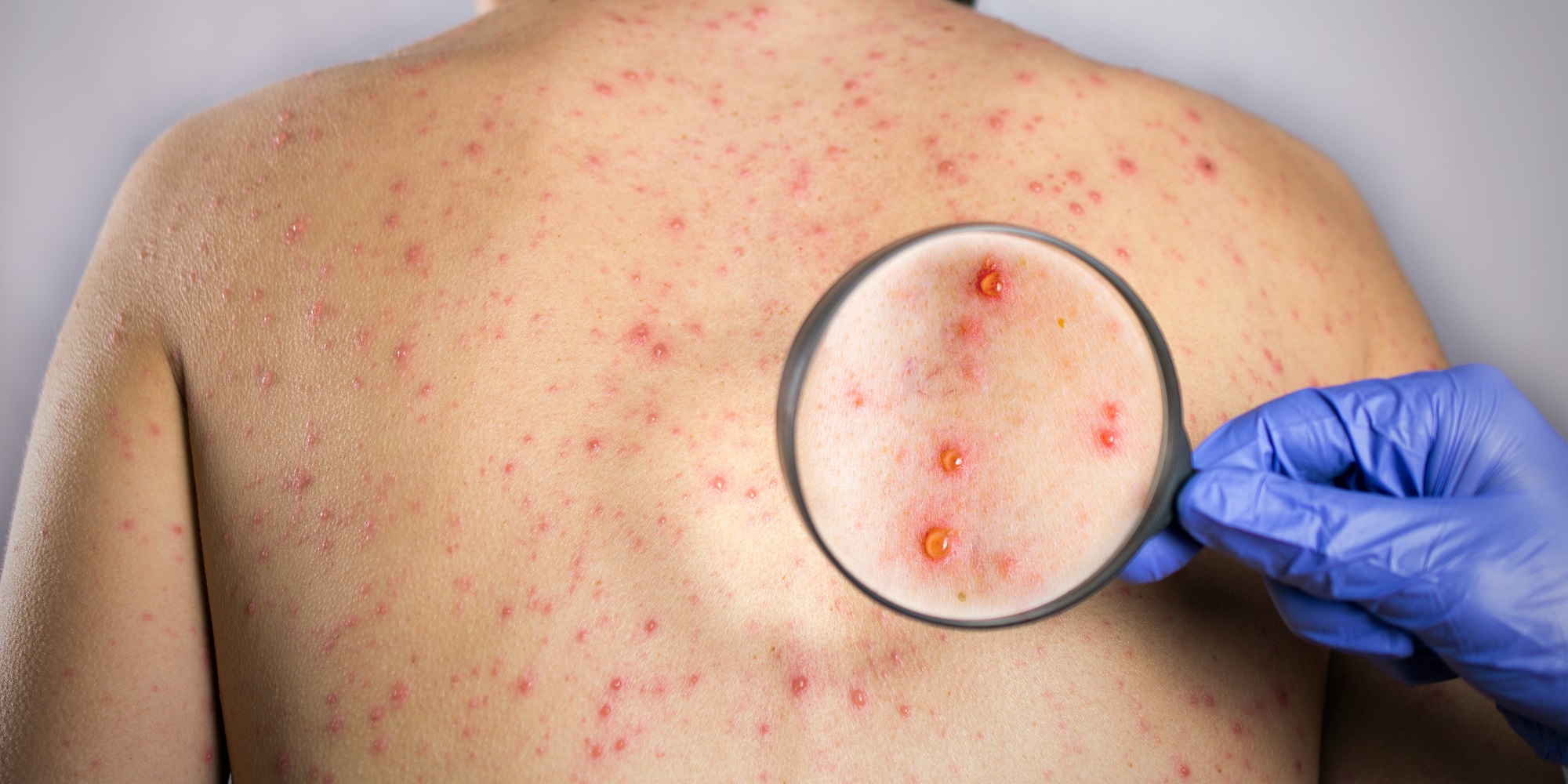 Rising Global Threat: Viral Skin Diseases Affecting Millions Each Year