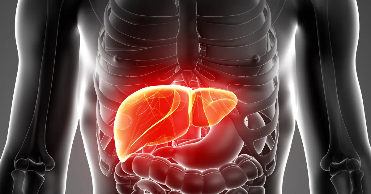 Risk of Fatty Liver: The Hidden Epidemic Affecting Millions Worldwide