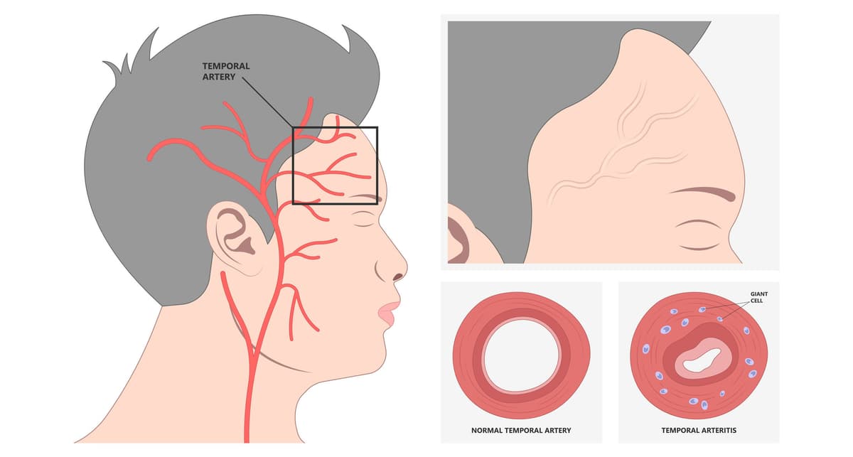 Secukinumab’s Limited Benefit in Giant Cell Arteritis: Key Study Insights