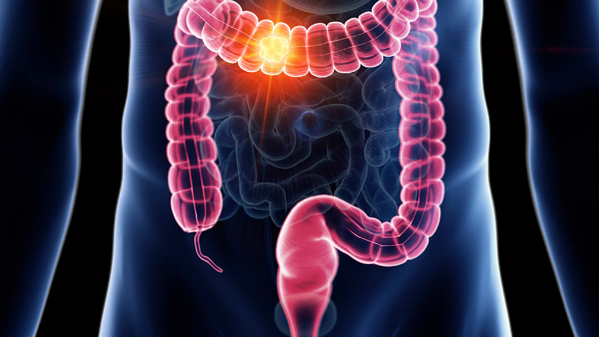 Surprising Study: Stool Test Rivals Colonoscopy in Colorectal Cancer Detection!