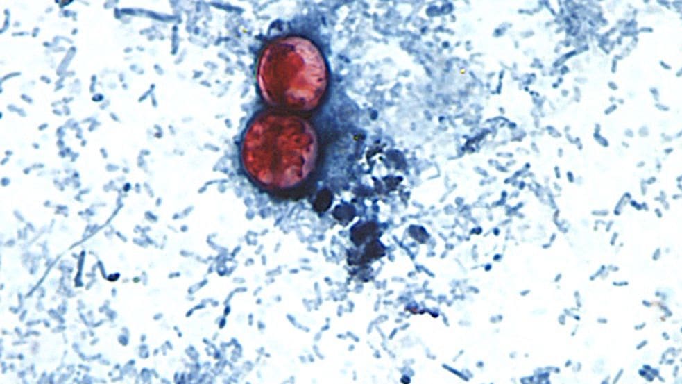 USA: Cyclospora Parasite Outbreak Causes Severe Diarrhea in 31 States
