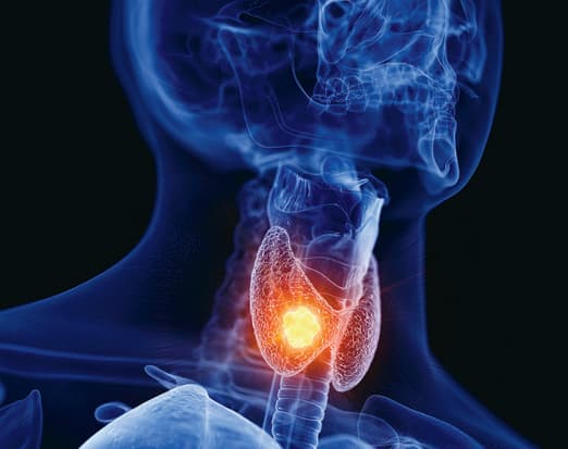 Understanding Thyroid Cancer: Risks, Diagnosis, and Treatment Insights