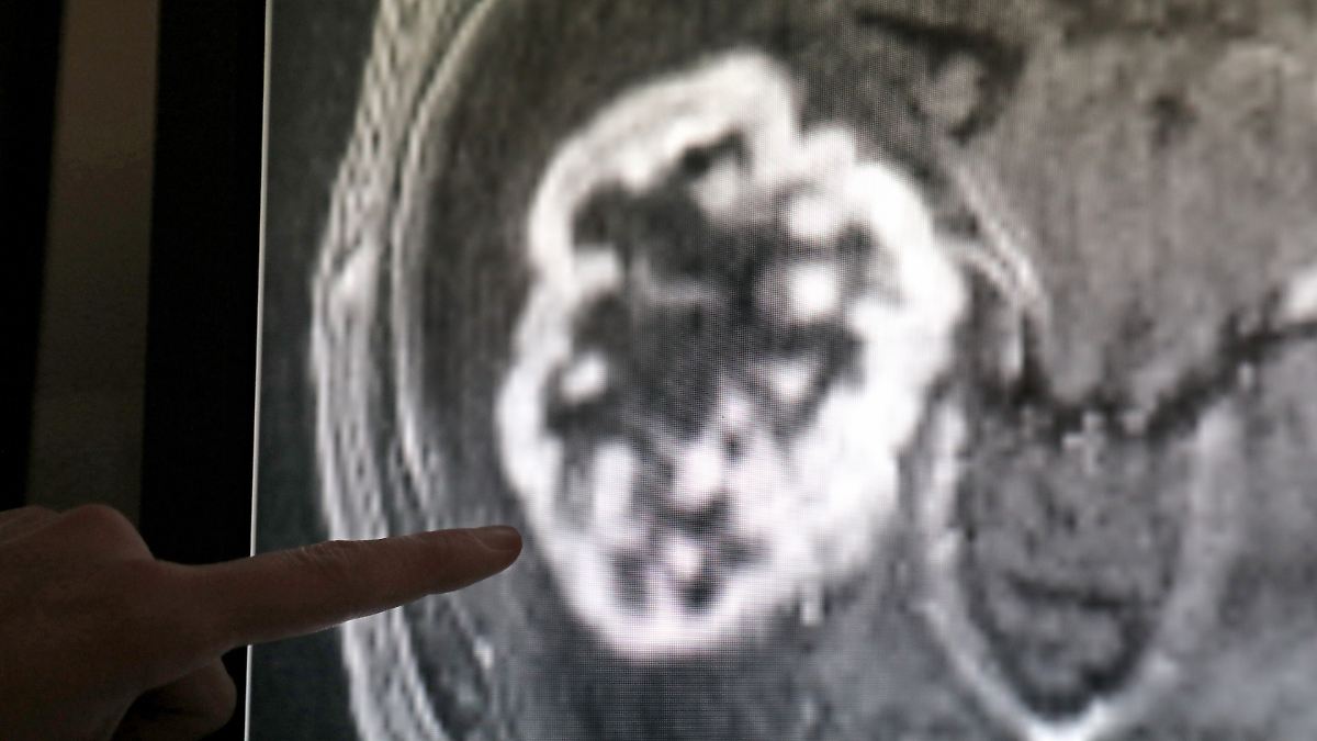Upcoming Cancer Diagnosis Surge: What You Need to Know for 2050