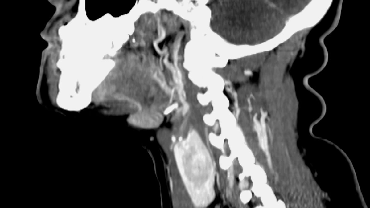 When is Thyroid Nodule Evaluation Truly Necessary? Find Out Now!