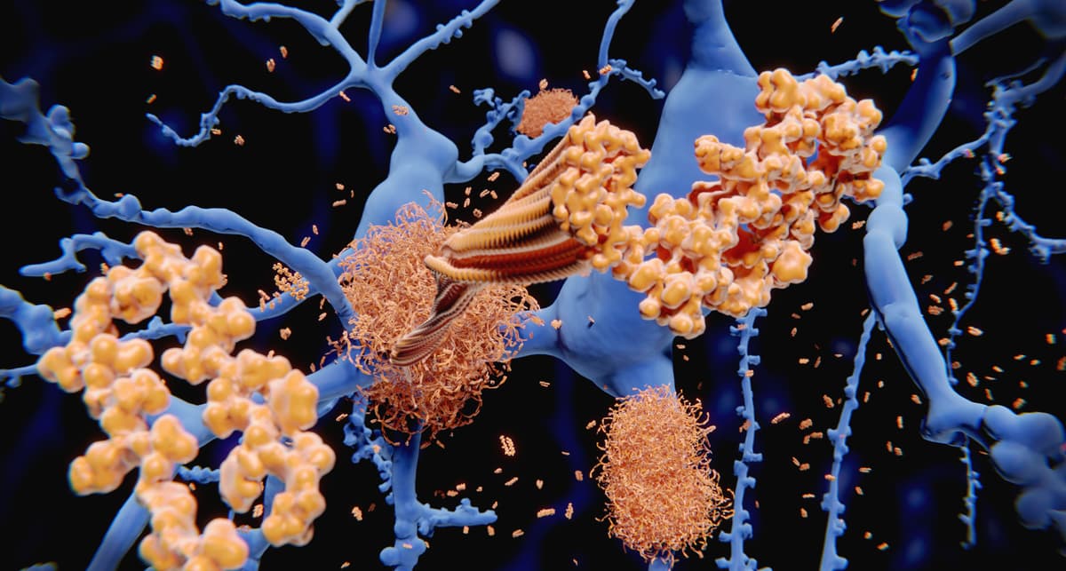Women Show Higher Alzheimer-Parkinson Co-Morbidity: Groundbreaking Findings
