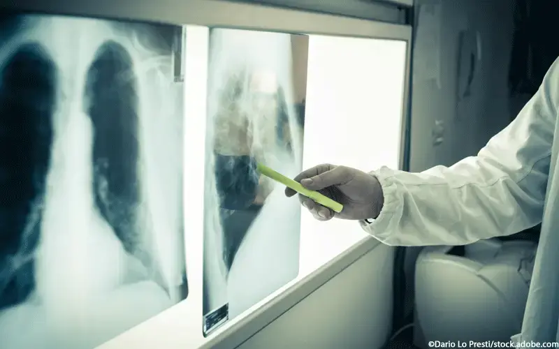 Low Light Exposure in Radiology: Hidden Burnout Risks Revealed